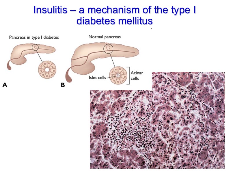Insulitis – a mechanism of the type I diabetes mellitus